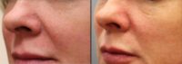 Woman treated with Diolite Laser Treatment to capillaries on nose immediate before & after