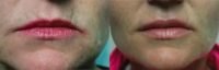 Vertical lip lines + lips treated with Restylane Silk