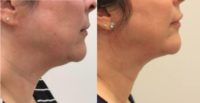 35-44 year old woman treated with FaceTite