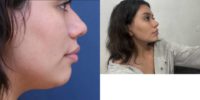 18-24 year old woman treated with Chin Filler