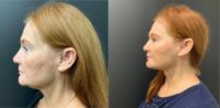 75 and up year old woman treated with SMAS Facelift