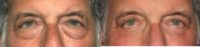 55-64 year old man treated with Eyelid Surgery