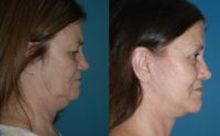 Face and Neck Lift Surgery Performed
