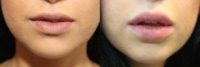 Injectable Fillers & Lip Augmentation