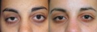 Injectables & Fillers for Eyelift