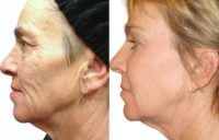 Laser Facial Rejuvenation