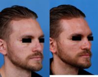 Man in his late 20s treated with Facial Reconstructive Surgery