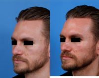 Man in his late 20s treated with Facial Reconstructive Surgery