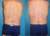 Man treated with CoolSculpting