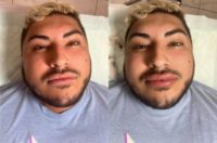 Man treated with Lip Fillers