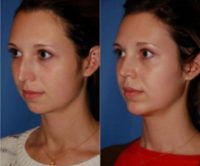 Woman treated with Chin Implant