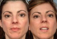Woman treated with Injectable Fillers
