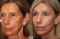 Woman treated with Deep Plane Facelift, Eyelid Surgery, Brow Lift
