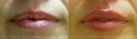 Natural looking Lip Enhancement / Lip Augmentation using Fillers to Contour Lips and Add Volume.
