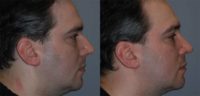 Rhinoplasty - 35 year old male, 6 months post-op