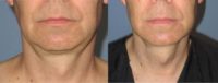 Liposuction (chin) with Thermi-Tight of the lower face and neck